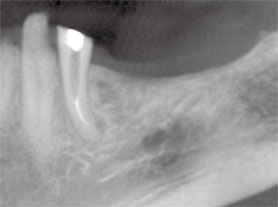 図2: 下歯槽神経上部における垂直的な骨量不足