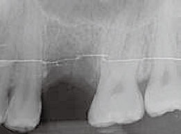 図1: 上術前の歯根尖端周囲のX線写真欠損歯